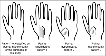 palmar hyperlinearity