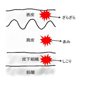 皮疹と病理の対応