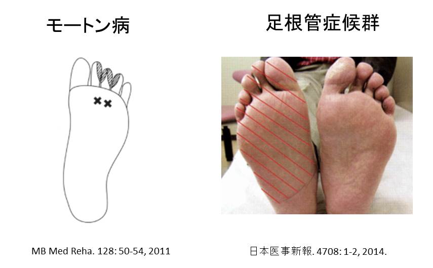 モートン病と足根管症候群