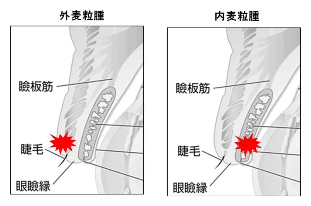 内麦粒腫と外麦粒腫の図