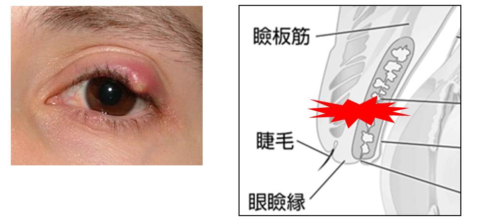 麦粒腫と霰粒腫の見分け方