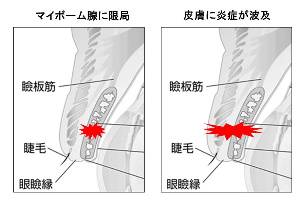 霰粒腫の図