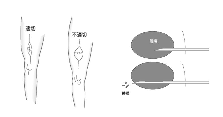 軟部腫瘍ガイドラインの図