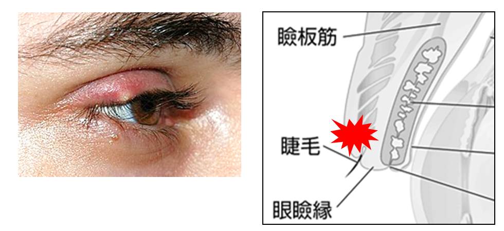 麦粒腫と霰粒腫の鑑別の図