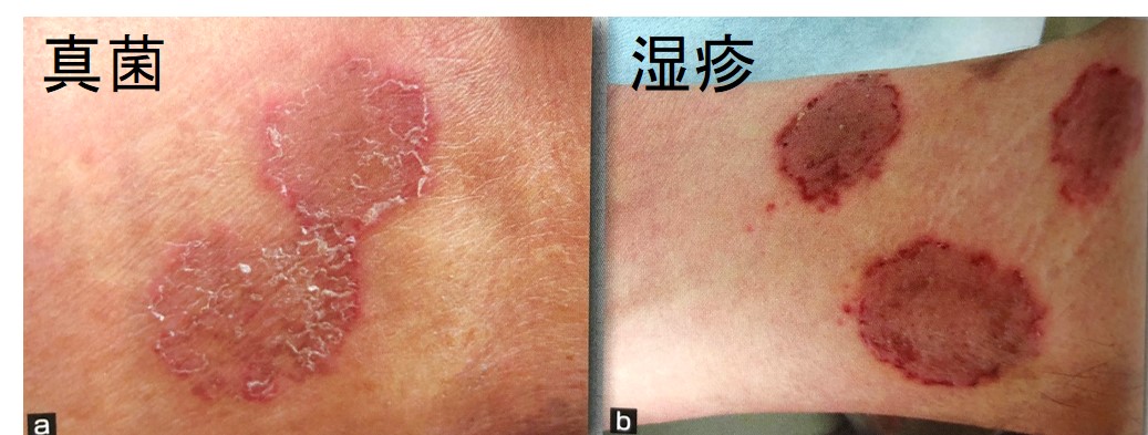 真菌感染症皮膚画像 | たむし 症状 写真 顔 , 『白癬』の原因・症状・治療法【症例画像】 – YRJKW