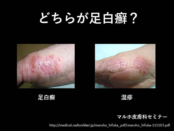 【文字で読むYoutube】動画で学ぶ皮膚疾患②水虫